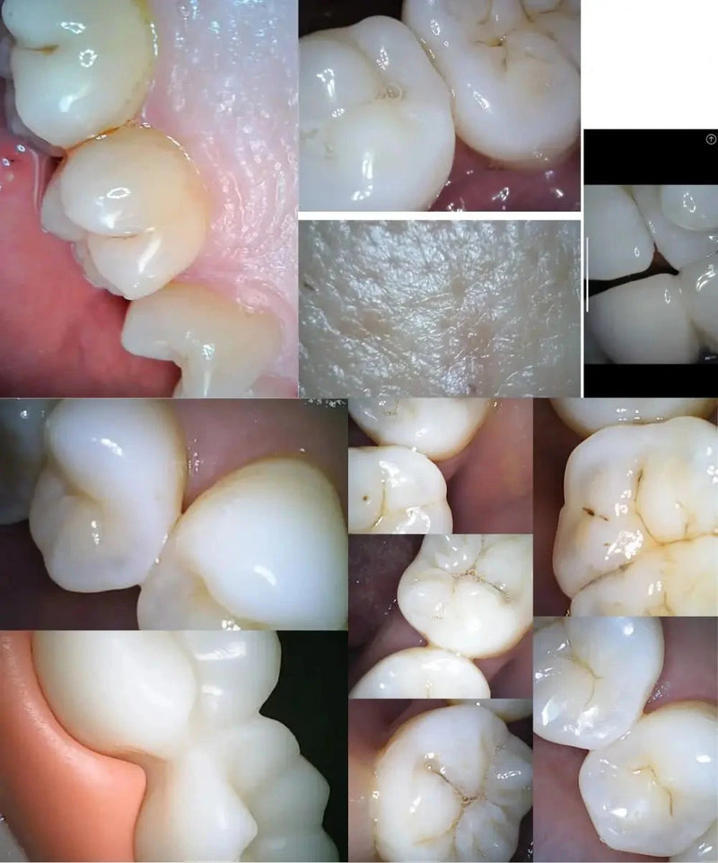 CÃMERA VISUAL SEM FIO INTRAORAL